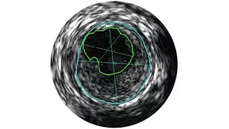 Клинические изображения Philips Visions PV (0,035 дюйма) катетер ротационный