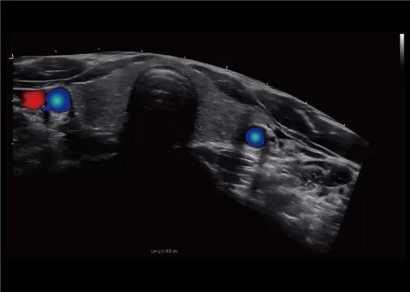 Клинические изображения УЗИ аппарат Chison CBit 10