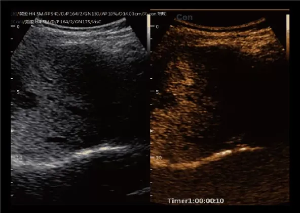 Клинические изображения УЗИ аппарат Chison CBit 10