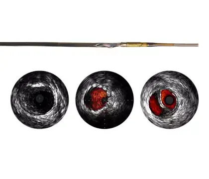 Philips Visions PV (0,018 дюйма) катетер ротационный