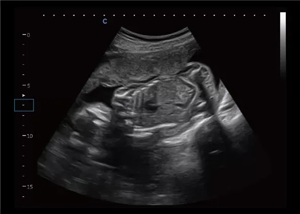 Клинические изображения УЗИ аппарат Chison CBit 9