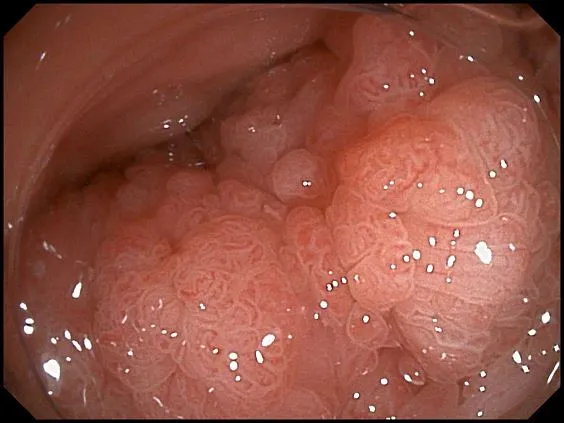 Клинические изображения SonoScape HD-500 видеоэндоскопическая система